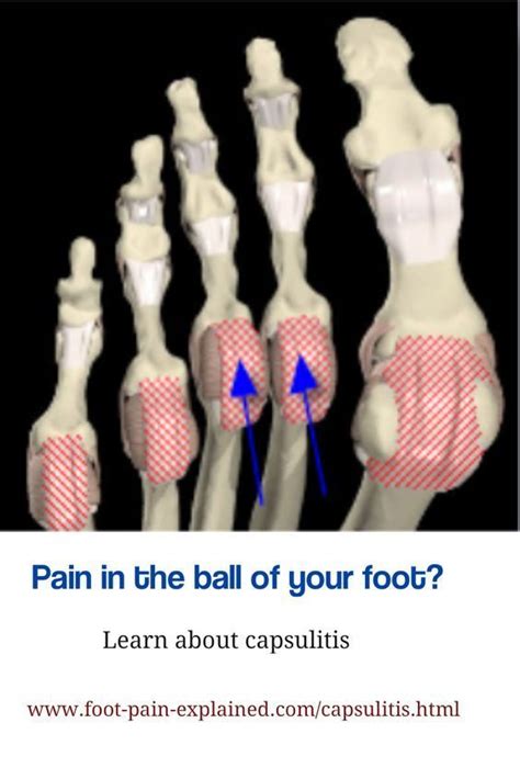 Pin On Foot Injuries And Sports Medicine