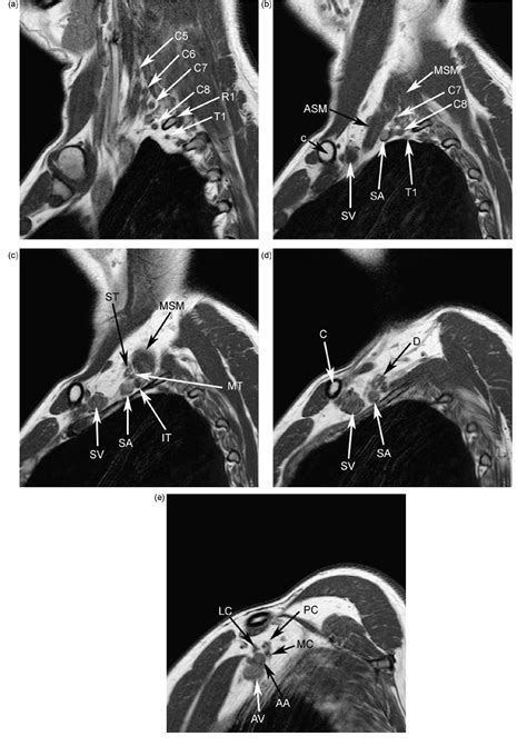 Figure 1 From Mri Of The Brachial Plexus A Pictorial Review