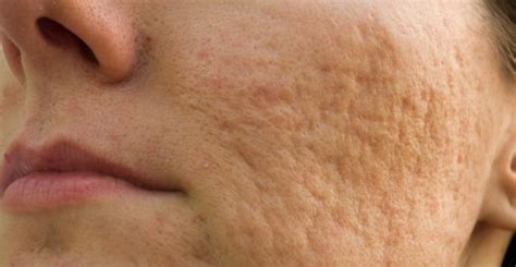 Acne Scarring Cincinnati Acne Scar Treatment Cincinnati