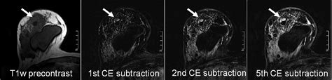 Benign Bi Rads 2 Lesions In Breast Mri Semantic Scholar
