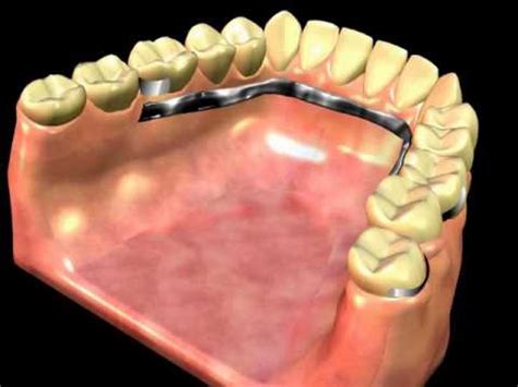 Dentures with precision attachments (clear or pink clasps) cost. Partial Denture Clasp - YouTube