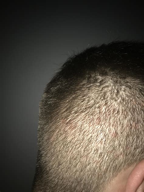 Red Spots On Scalp And Hair Loss
