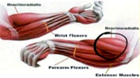 Treatment And Causes Of Forearm Pain Youtube