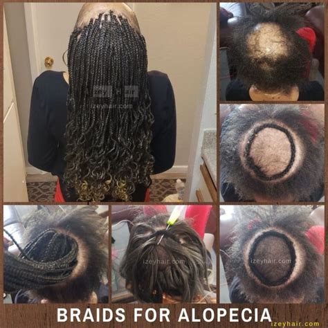 33 Hairstyles For Alopecia Sufferers Ghaliahnerys