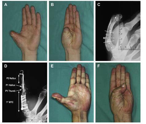 Primary Thumb Reconstruction In A Mutilated Hand Dr Piñal
