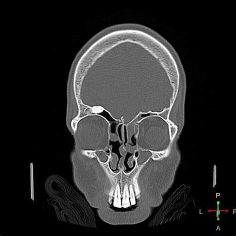 Osteom Sinus Frontalis Pacs