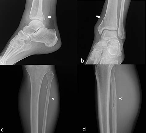 Maisonneuve Fracture Ankle Ankle Fractures Special Situations