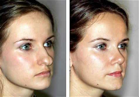 Dr Steven Denenbergs Facial Plastic Surgery Before And