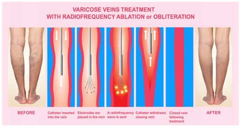 Everything To Know About Varicose Veins In Pregnancy Specialist Vein