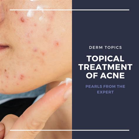 Topical Treatment Of Acne Pearls From The Expert Next Steps In