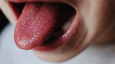 Big Tongue Macroglossia Symptoms Causes And Treatment