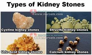 Types Of Kidney Stones Nurselk Com