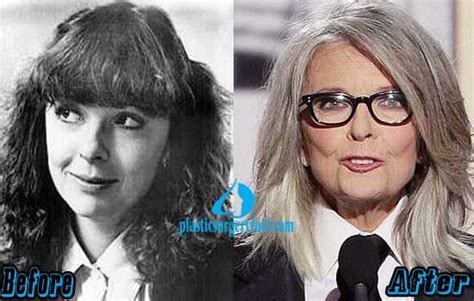 Diane Keaton Plastic Surgery Before And After Photos Diane Keaton Plastic Surgery Plastic