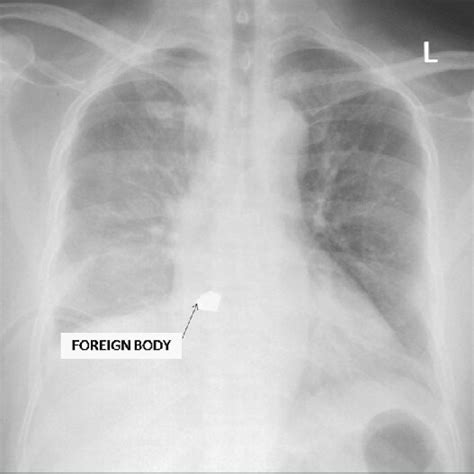 Chest X‑ray Posteroanterior View Showing Foreign Body Marked With Arrow
