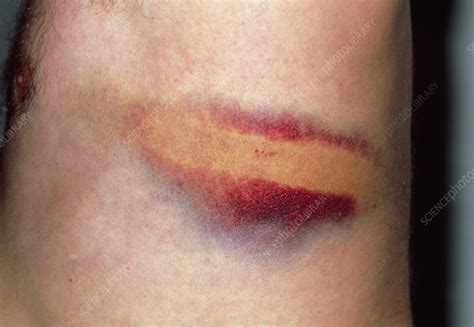 Rib Bruising Following Assault With Iron Bar Stock Image M3300545