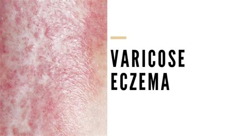 Whats To Know About Varicose Eczema