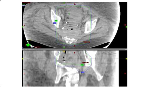 Radiation Dose Distribution Images Superimposed On Ct Angio Abdomen And