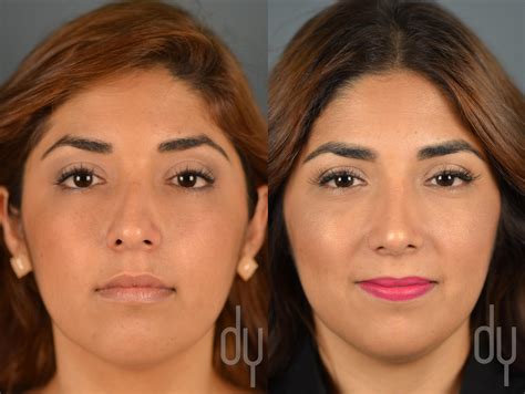 Rhinoplasty Nose Job Before And After Recovery Experience Beverly Hills Beverly Hills