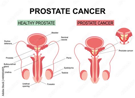 Prostate Cancer On White Background Illustration Anatomy Of The Male Reproductive Organs