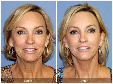 Facelift Fifties Before And After Photos Patient 77 Dr Kevin Sadati