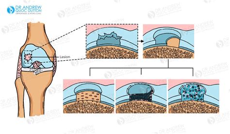 Cartilage Regeneration Singapore Benefits Risks And Recovery