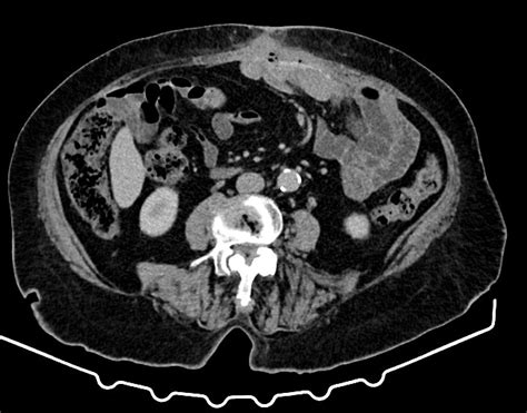Enterocutaneous Fistula Radiology Case