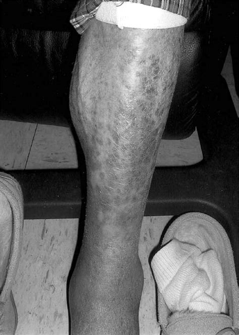 Photograph Showing Purpura On The Patients Leg Download Scientific