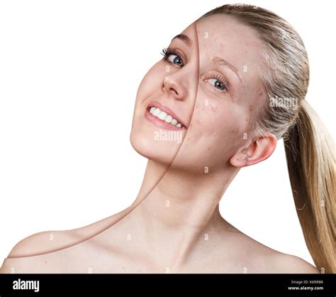 Woman With Acne Before And After Treatment Stock Photo Alamy