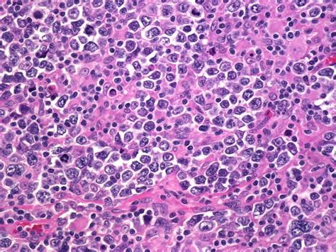 Centroblastic Variant Of Diffuse Large B Cell Lymphomas Shown Here Is
