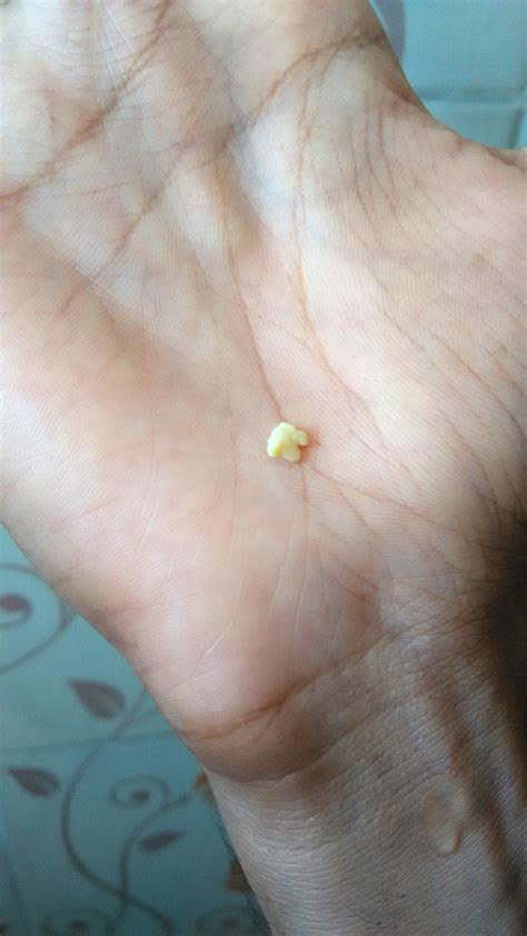 This Tonsil Stone Came Out After Coughing So Hard Tonsilstones