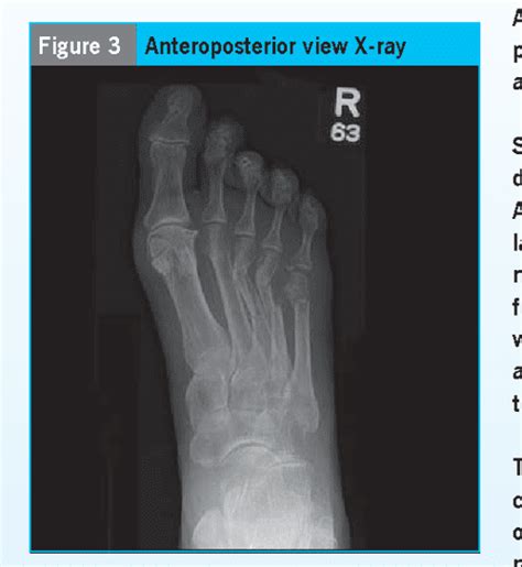 Figure 3 From Avulsion Fracture Of The Calcaneal Tuberosity Diagnosis