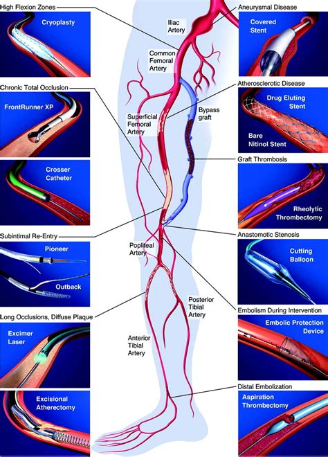 Overview Of New Technologies For Lower Extremity Revascularization
