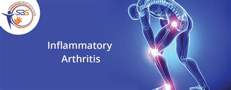 Sbs Rehabilitation Center Inflammatory Arthritis And Its Treatment