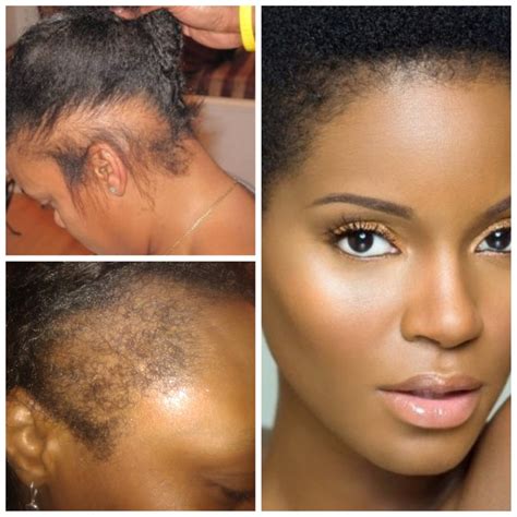 Repair A Damaged Hairline And Prevent Future Hair Loss With Nutresshair Protective Hairstyles