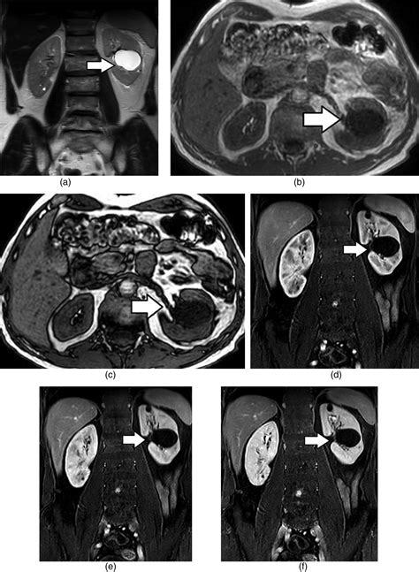 Cross Sectional Imaging Assessment Of Renal Masses With Emphasis On MRI