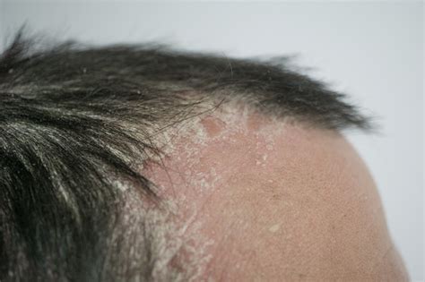 Psoriasis On The Hairline And On The Scalpclose Up Dermatological