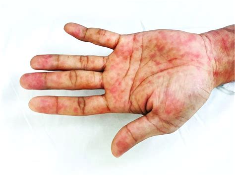 Tropicalmed Free Full Text A Case Report Of Secondary Syphilis Co