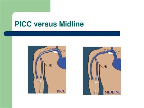 Midline Catheter Vs Picc Line
