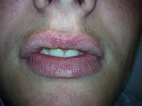 How To Get Rid Of Fordyce Spots On Lips