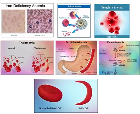 Different Types Of Anemia