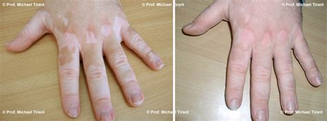 Before And After Patient Photographs Vitiligo Repigmentation Cream