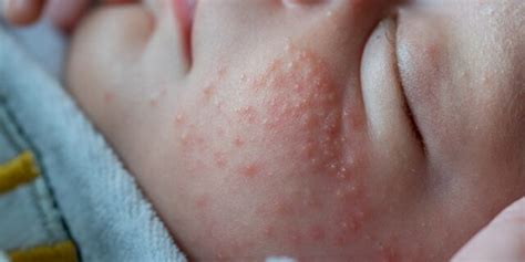 Dermatite Atopica Nel Neonato Cause Sintomi E Rimedi Gravidanzaonline