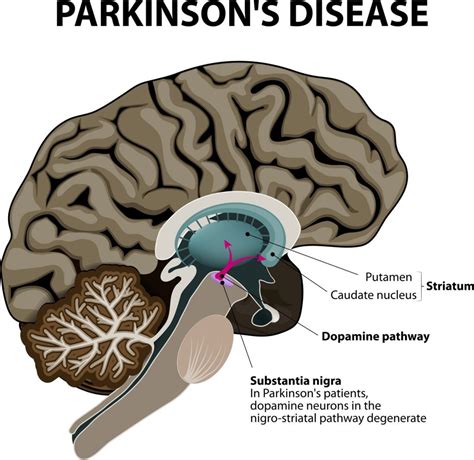 Causes Parkinsons Disease Brain