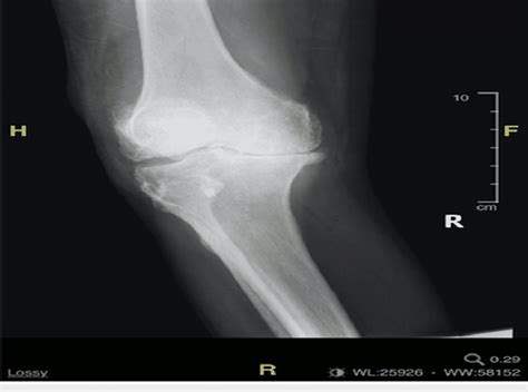 Anteroposterior Radiograph Of The Right Knee Download Scientific Diagram
