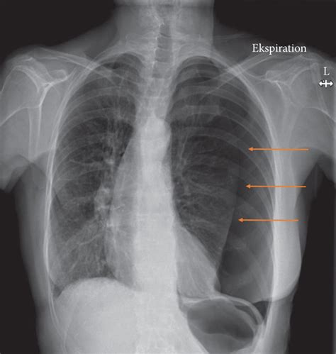 A Chest X Ray Showing Tension Pneumothorax Of The Left Lung The