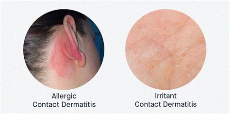 Everything You Need To Know About Contact Dermatitis Slmd Skincare By
