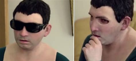 Man Allergic To Sun Gets A ‘second Skin Mask To Protect His Face