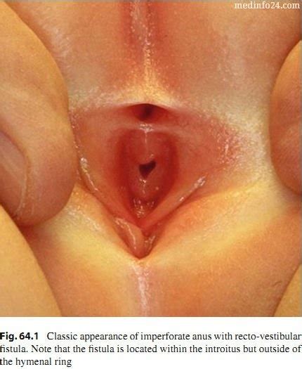 Prepubertal Vagina Examination Telegraph Findsource Findsource