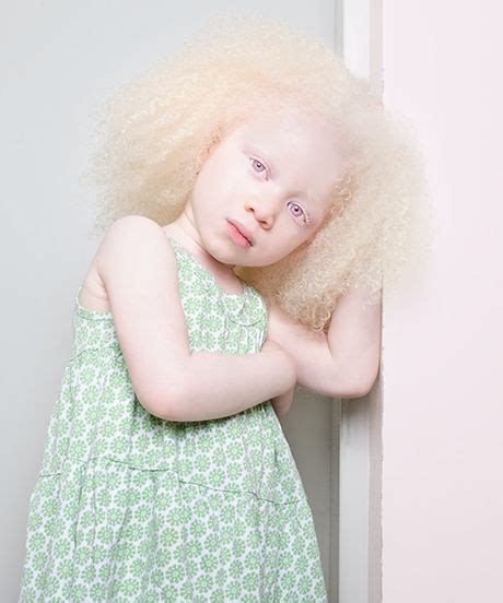 This Photo Series Shows Albinism In A Whole New Light Refinery