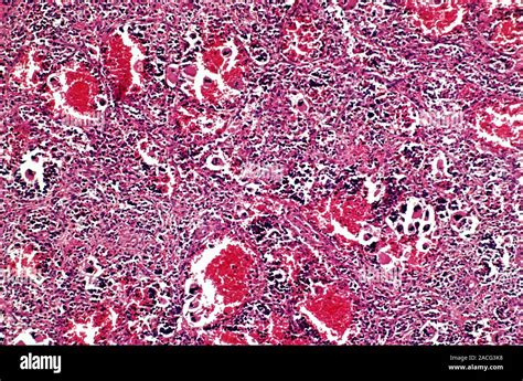 Spleen In Myelofibrosis Light Micrograph Of A Section Through A Spleen